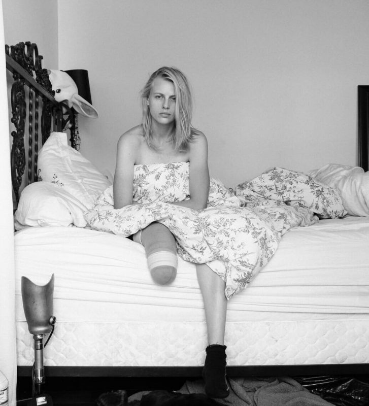 Фотография: Трагическая история Лорен Вассер, которая лишилась ног после использования тампонов №4 - BigPicture.ru