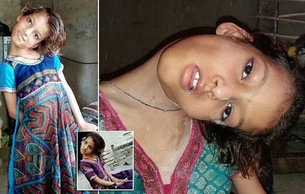 Мир под прямым углом: шея 11-летней пакистанки вывернута на 90 градусов