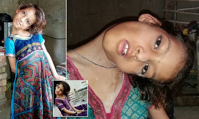 Фотография: Мир под прямым углом: шея 11-летней пакистанки вывернута на 90 градусов №1 - BigPicture.ru