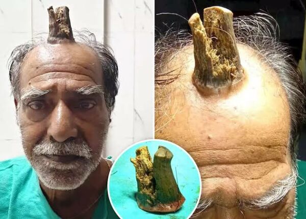 Человек-единорог: 74-летнему индийцу удалили жуткий нарост на голове