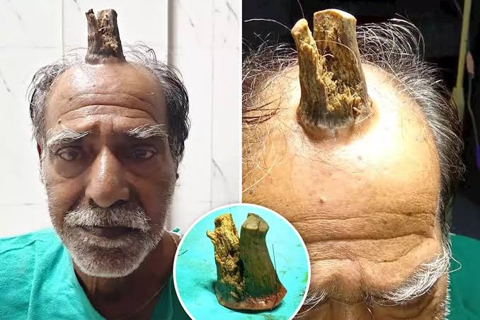 Фотография: Человек-единорог: 74-летнему индийцу удалили жуткий нарост на голове №1 - BigPicture.ru
