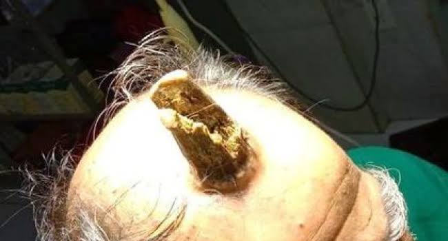 Фотография: Человек-единорог: 74-летнему индийцу удалили жуткий нарост на голове №6 - BigPicture.ru