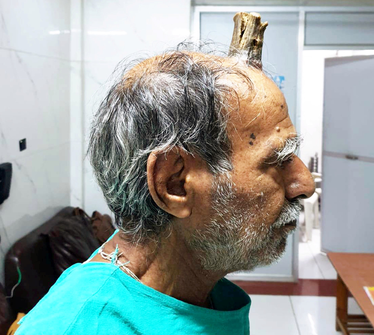 Фотография: Человек-единорог: 74-летнему индийцу удалили жуткий нарост на голове №5 - BigPicture.ru