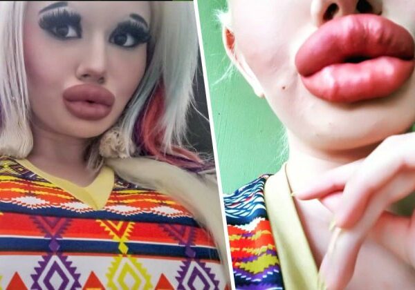 Тяга к прекрасному: болгарская студентка увеличивает губы и не может остановиться