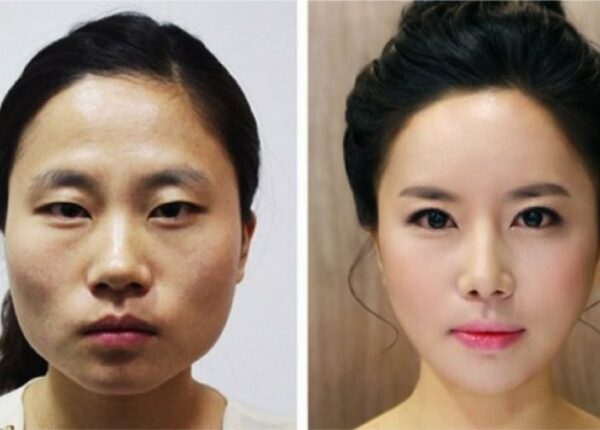 «Вишневые губы», уменьшение челюсти, пластика ноздрей: какие операции популярны в Южной Корее