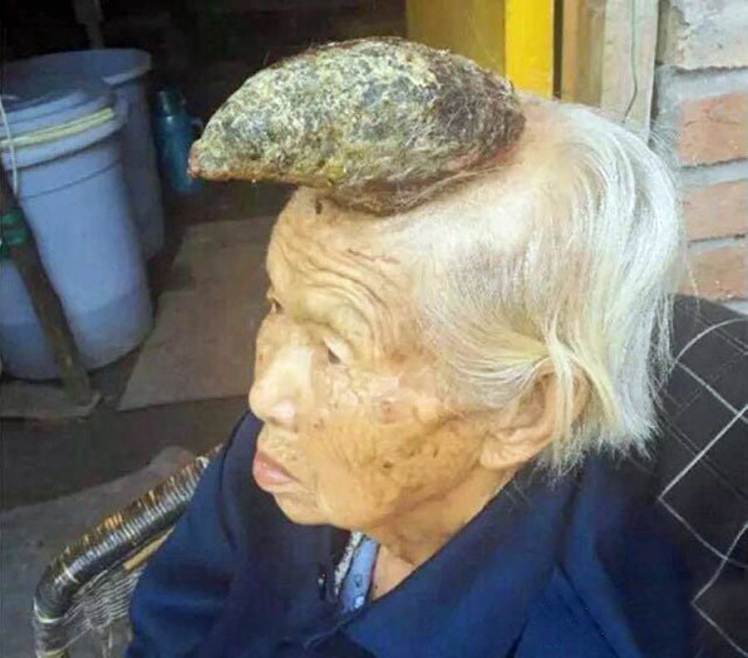 Фотография: Человек-единорог: 74-летнему индийцу удалили жуткий нарост на голове №2 - BigPicture.ru