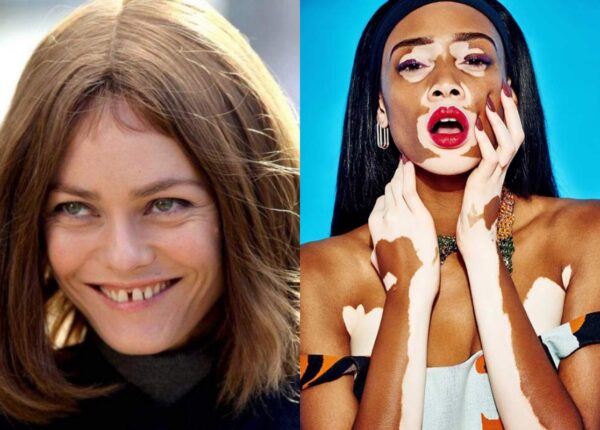 5 знаменитостей, которых мы любим, несмотря на дефекты их внешности