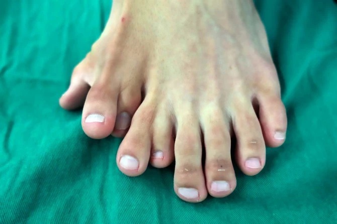 Фотография: Счастья много не бывает: китаец долго жил с 14 пальцами на ногах, считая аномалию счастливым знаком №1 - BigPicture.ru