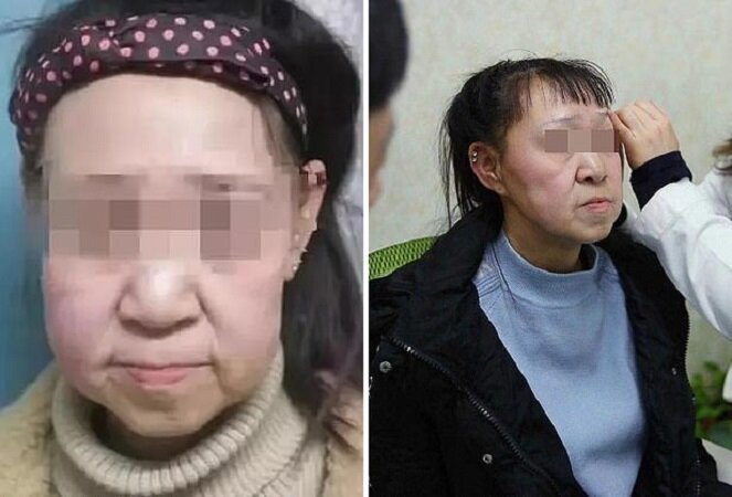 Фотография: Из бабушки в девочку: 15-летней китаянке с лицом старушки сделали операцию №6 - BigPicture.ru