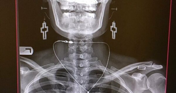 Богатый внутренний мир — 17 рентгеновских снимков, которые врачи не сразу развидят