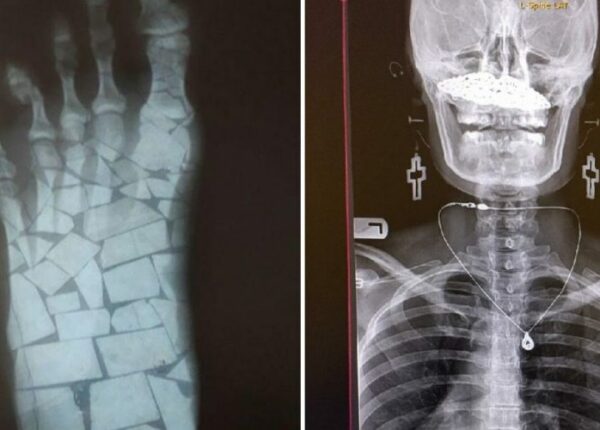 Богатый внутренний мир: 17 рентгеновских снимков, которые врачи не сразу развидят
