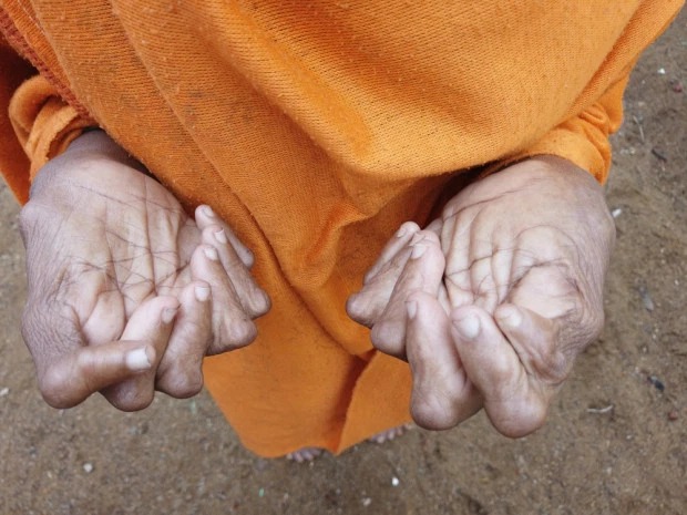 Фотография: Пальцы веером: женщина с 31 пальцем попала в Книгу рекордов Гиннесса №6 - BigPicture.ru