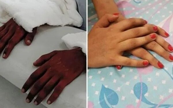 Девушке из Индии пересадили мужские руки, спустя год они посветлели и лишились волос