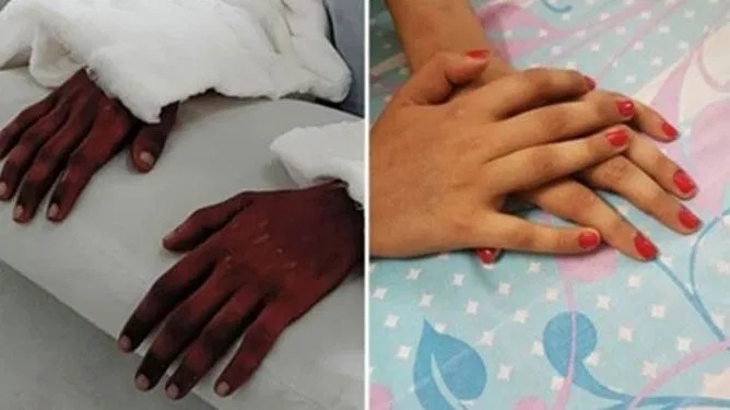 Фотография: Девушке из Индии пересадили мужские руки, спустя год они посветлели и лишились волос №1 - BigPicture.ru