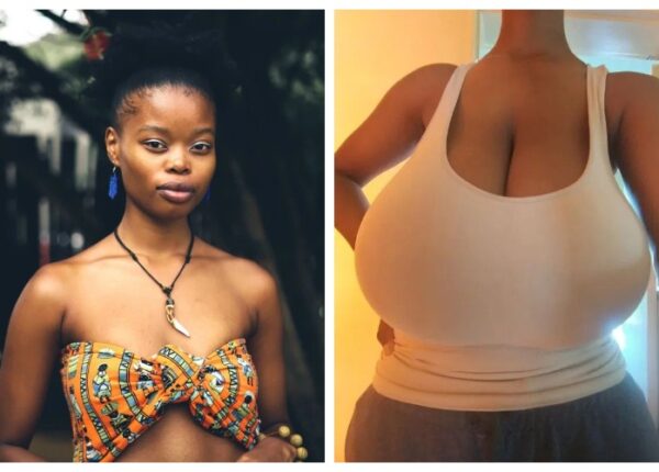 Как камень с души: жизнь девушки с 13 размером груди кардинально изменилась после операции по уменьшению бюста