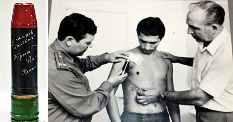 Фотография: Как советские хирурги разминировали живого человека №1 - BigPicture.ru