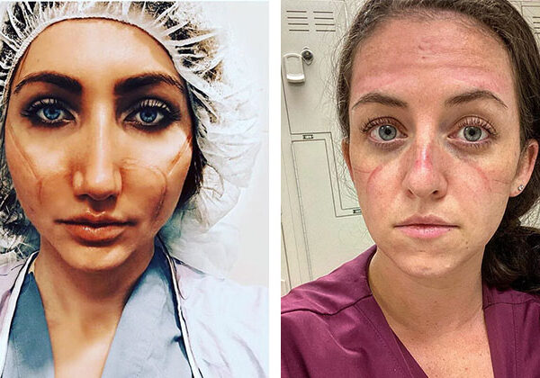 «Эти раны не пройдут — они останутся внутри нас»: фото девушек-медиков со следами от масок на лицах