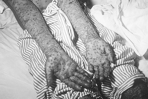 Фотография: Как за месяц предотвратили эпидемию черной оспы в Москве в 1960 году №3 - BigPicture.ru