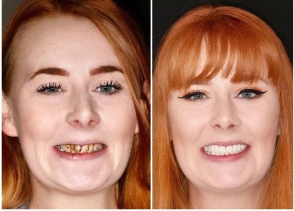 С улыбкой по жизни: Как преобразилась девушка с ужасными зубами