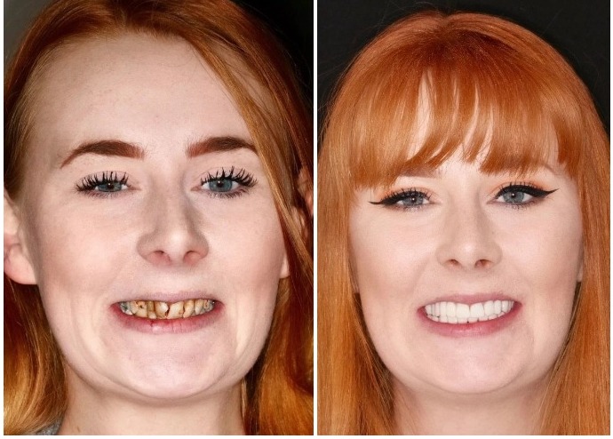 Фотография: С улыбкой по жизни: Как преобразилась девушка с ужасными зубами №1 - BigPicture.ru