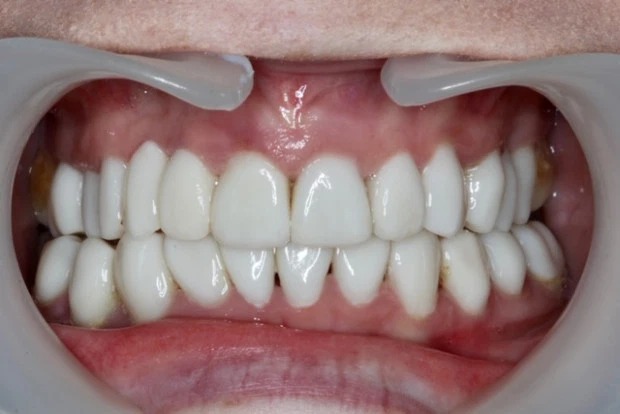 Фотография: С улыбкой по жизни: Как преобразилась девушка с ужасными зубами №4 - BigPicture.ru