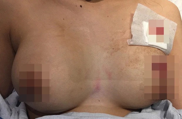 Фотография: Подушка безопасности: истории женщин, которым грудные импланты спасли жизнь №4 - BigPicture.ru