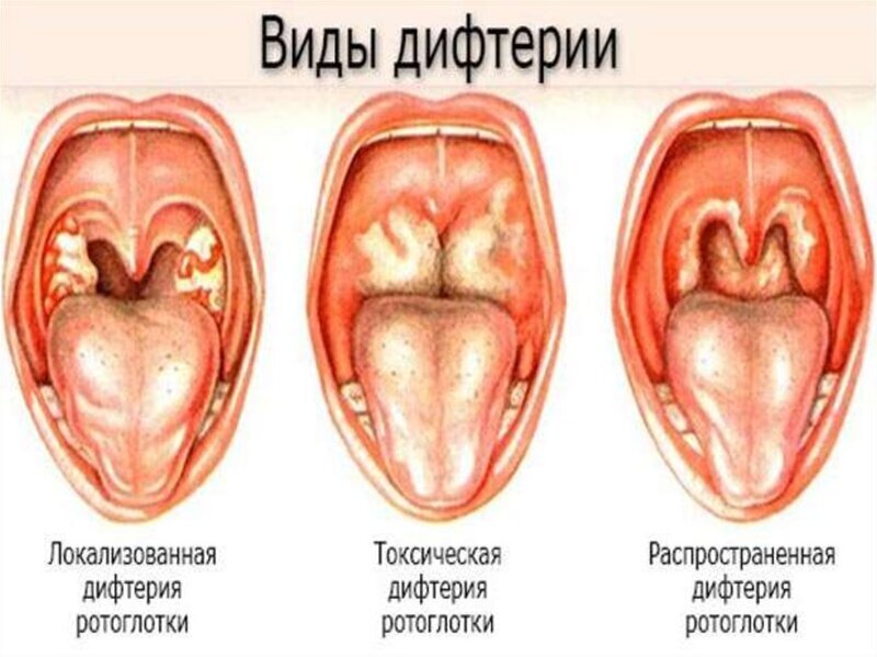 Фотография: Братство, объединенное шрамами: от каких болезней делают прививки №6 - BigPicture.ru
