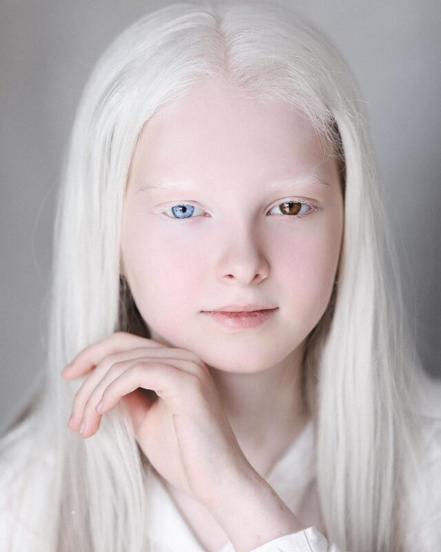 Фотография: Девочка-альбинос из Чечни поразила своей уникальной внешностью №2 - BigPicture.ru