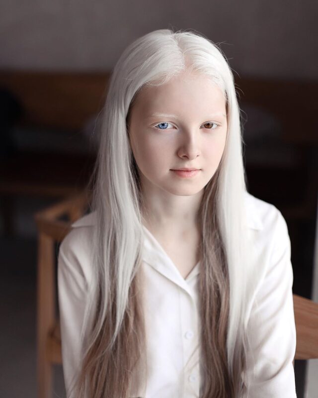 Фотография: Девочка-альбинос из Чечни поразила своей уникальной внешностью №7 - BigPicture.ru