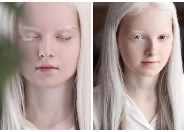 Девочка-альбинос из Чечни поразила своей уникальной внешностью