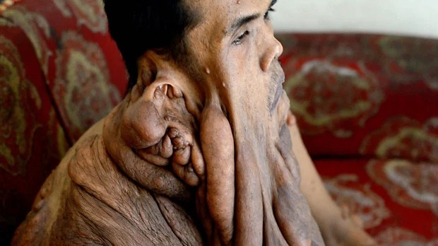 Фотография: Индонезиец с 38-килограммовой опухолью на лице мечтает об операции №3 - BigPicture.ru