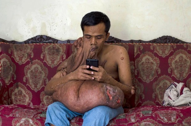 Фотография: Индонезиец с 38-килограммовой опухолью на лице мечтает об операции №4 - BigPicture.ru