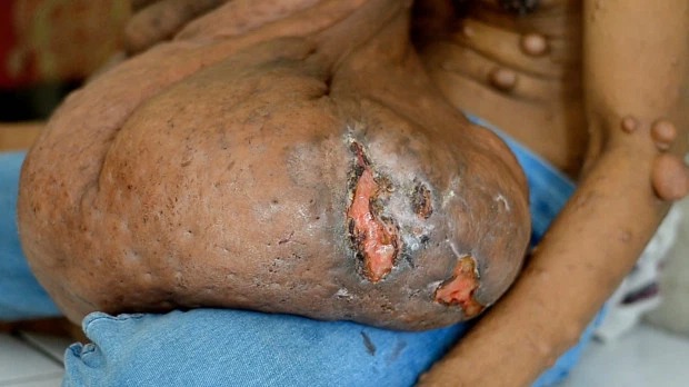 Фотография: Индонезиец с 38-килограммовой опухолью на лице мечтает об операции №5 - BigPicture.ru