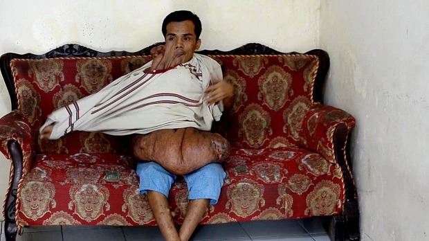 Фотография: Индонезиец с 38-килограммовой опухолью на лице мечтает об операции №2 - BigPicture.ru