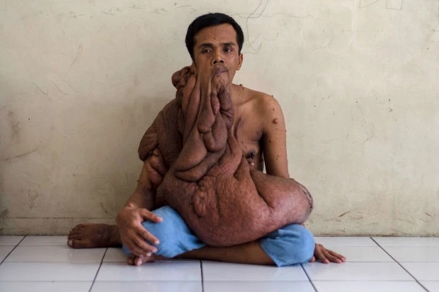 Фотография: Индонезиец с 38-килограммовой опухолью на лице мечтает об операции №1 - BigPicture.ru