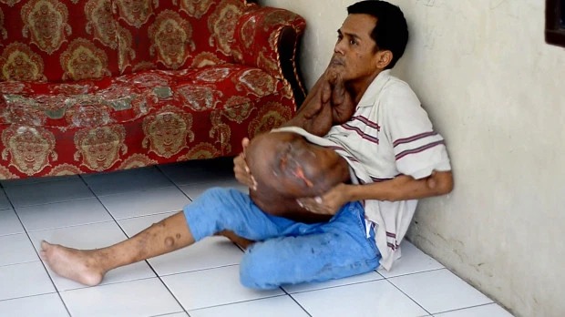 Фотография: Индонезиец с 38-килограммовой опухолью на лице мечтает об операции №7 - BigPicture.ru