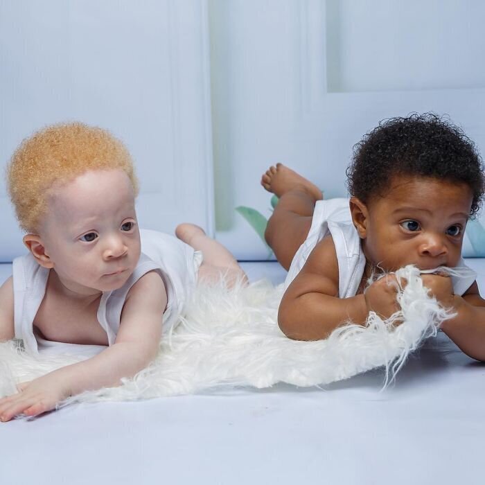 Фотография: В чем секрет близнецов с разным цветом кожи из Нигерии №7 - BigPicture.ru