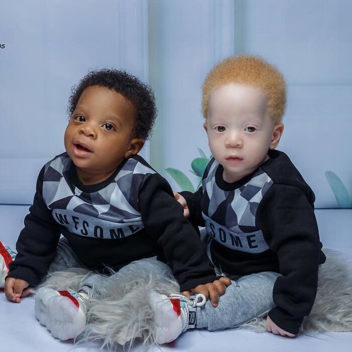 Фотография: В чем секрет близнецов с разным цветом кожи из Нигерии №9 - BigPicture.ru