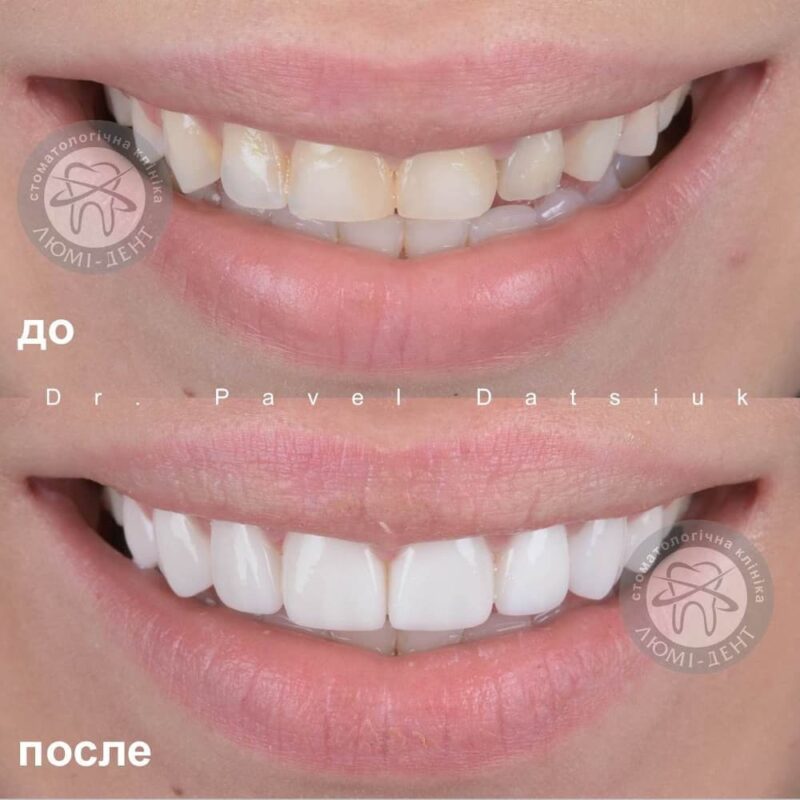 Фотография: Современные анестетики в стоматологии – что выбрать для обезболивания в стоматологии №2 - BigPicture.ru