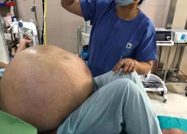 52-летней жительнице Индии удалили опухоль яичников весом 50 кило