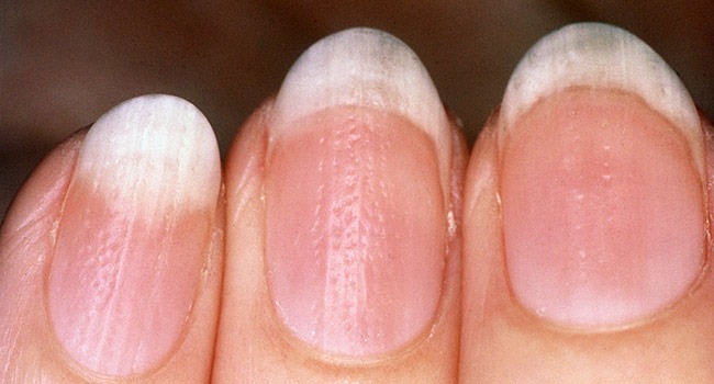 Фотография: От артрита до меланомы: 10 признаков серьезных заболеваний, которые можно определить по ногтям №8 - BigPicture.ru