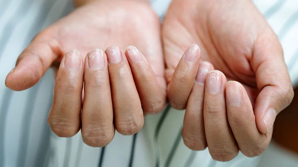 Фотография: От артрита до меланомы: 10 признаков серьезных заболеваний, которые можно определить по ногтям №9 - BigPicture.ru