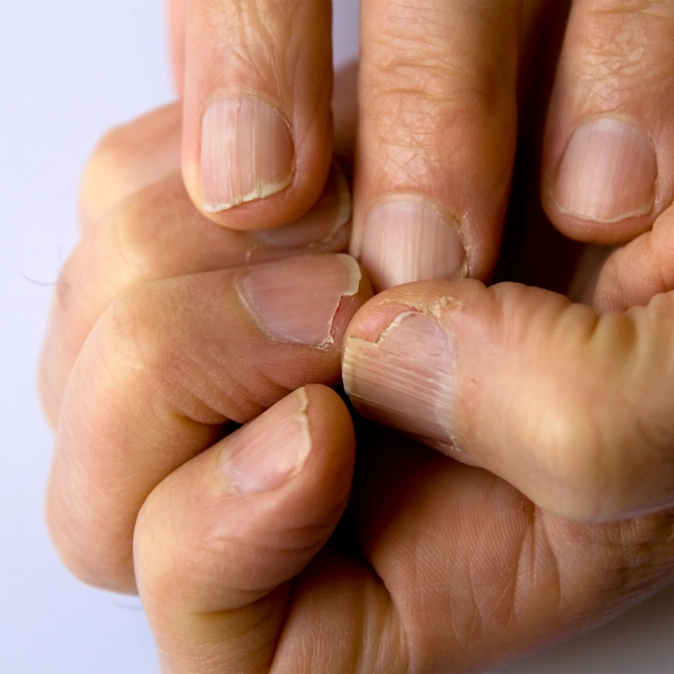 Фотография: От артрита до меланомы: 10 признаков серьезных заболеваний, которые можно определить по ногтям №7 - BigPicture.ru