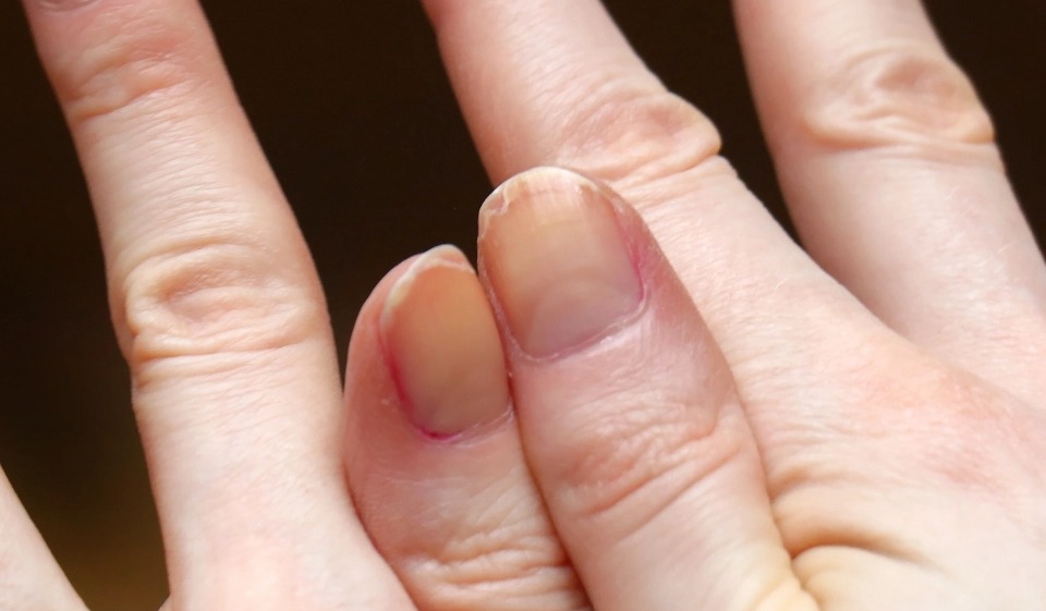 Фотография: От артрита до меланомы: 10 признаков серьезных заболеваний, которые можно определить по ногтям №4 - BigPicture.ru