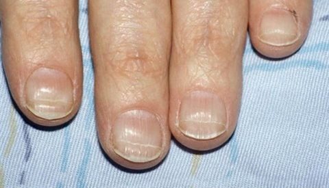 Фотография: От артрита до меланомы: 10 признаков серьезных заболеваний, которые можно определить по ногтям №10 - BigPicture.ru