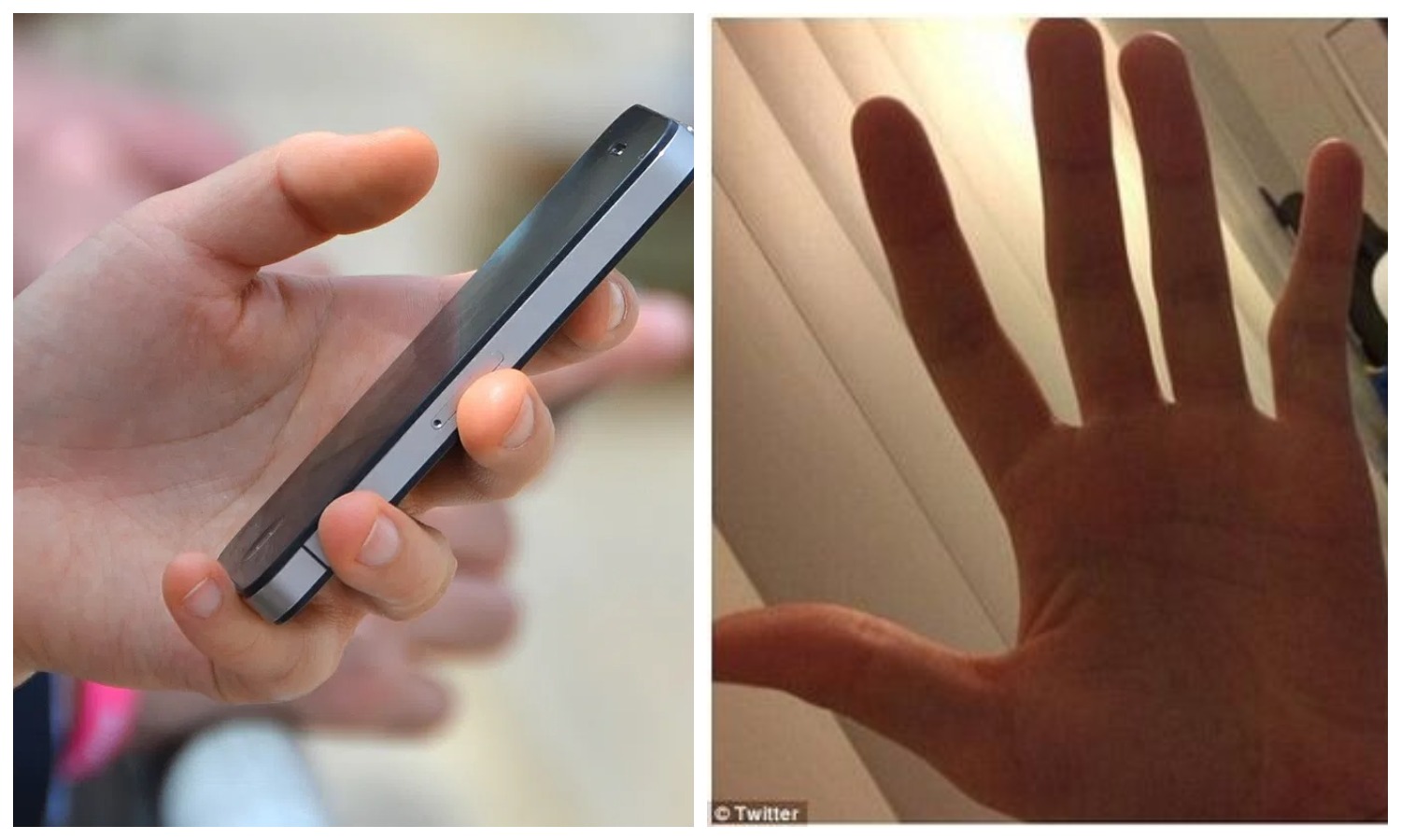 Фотография: Смарт-мизинец: у пользователей смартфонов все чаще встречается деформация пальца №1 - BigPicture.ru