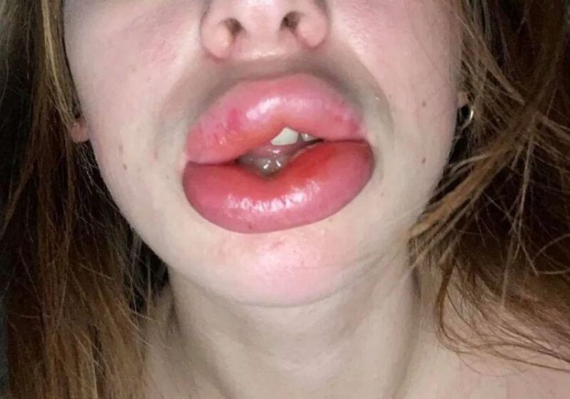Фотография: Девушка хотела увеличить губы гелем, но ситуация вышла из под контроля №4 - BigPicture.ru