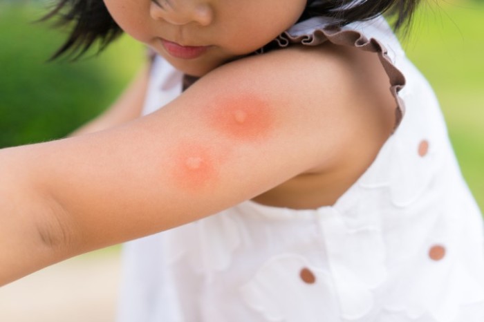 Фотография: Как кусает комар и почему комариный укус так чешется №5 - BigPicture.ru