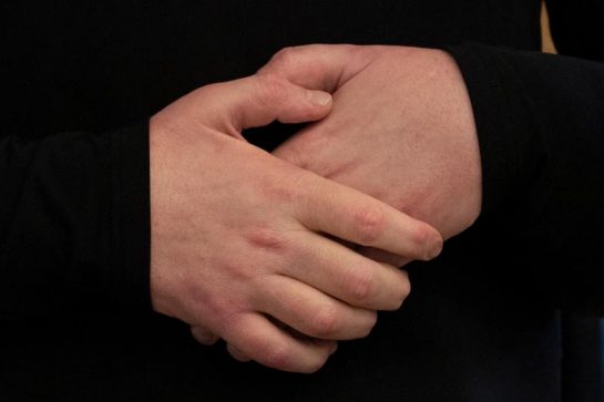Фотография: Пострадавшему в аварии американцу впервые в мире пересадили лицо и обе руки №7 - BigPicture.ru