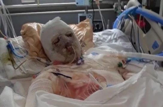 Фотография: Пострадавшему в аварии американцу впервые в мире пересадили лицо и обе руки №5 - BigPicture.ru
